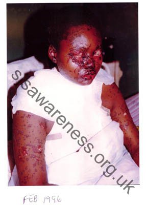 17 year old with stevens - jonson syndrome